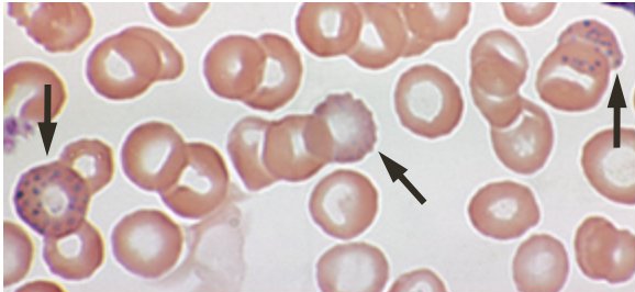 blood-film-anemia-lead