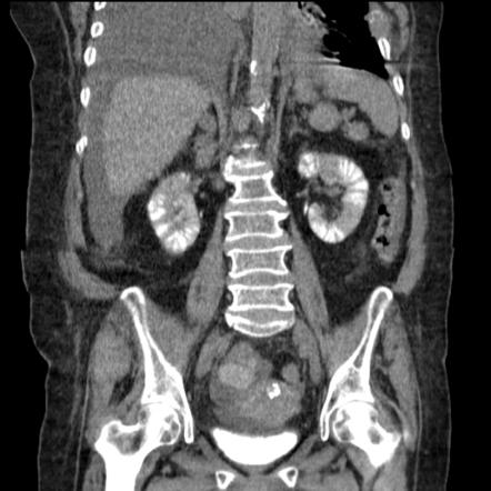 CONTRAST INDUCED AKI