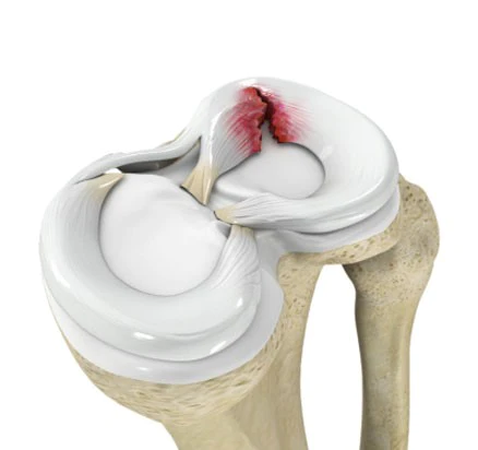 knee-menisci-injury