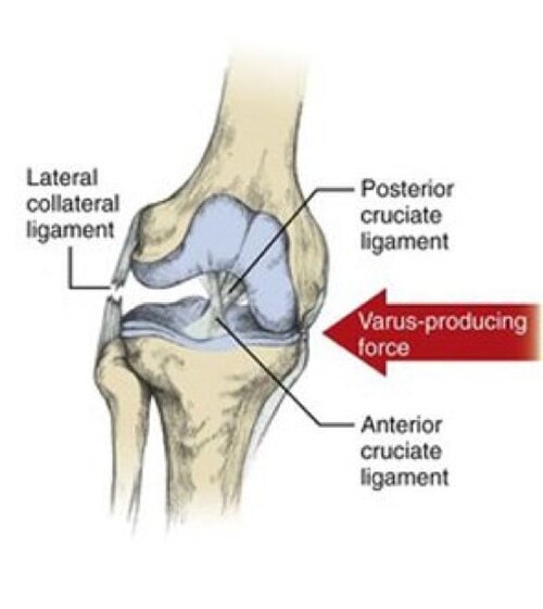 lateral-collateral-ligament