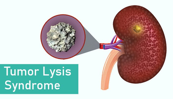 TUMOR LYSIS SYNDROME