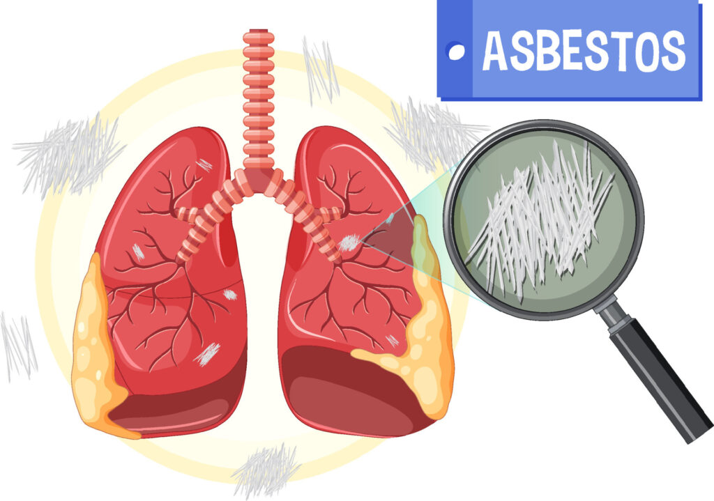 lungs with asbestosis