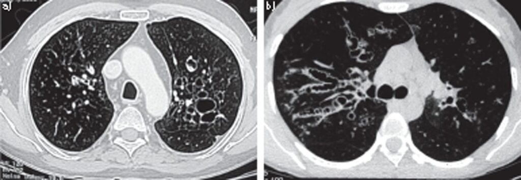 hrct chest