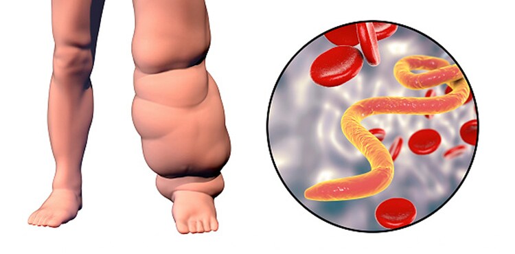 swollen-leg-parasite