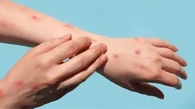 hand-with-rashes